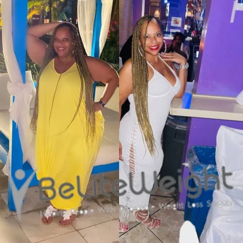 Weight Loss Surgery Before And After